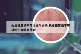 頭皮銀屑病不可以吃牛肉嗎 頭皮銀屑病不可以吃牛肉嗎為什么