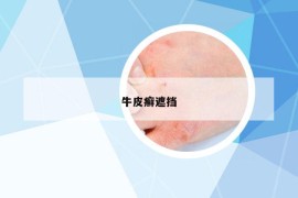 牛皮癬遮擋