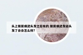 頭上銀屑病燙頭發(fā)之后有的 銀屑病燙發(fā)染頭發(fā)了會會怎么樣?