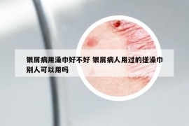 銀屑病用澡巾好不好 銀屑病人用過的搓澡巾別人可以用嗎