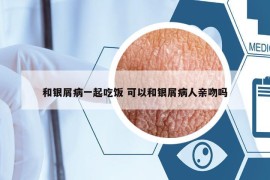 和銀屑病一起吃飯 可以和銀屑病人親吻嗎