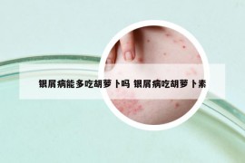 銀屑病能多吃胡蘿卜嗎 銀屑病吃胡蘿卜素
