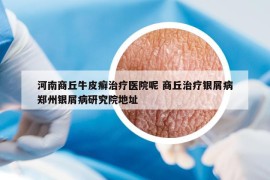 河南商丘牛皮癬治療醫(yī)院呢 商丘治療銀屑病鄭州銀屑病研究院地址