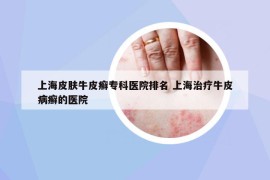 上海皮膚牛皮癬?？漆t(yī)院排名 上海治療牛皮病癬的醫(yī)院