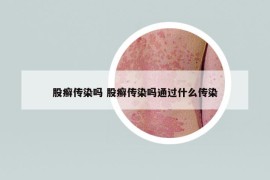 股癬傳染嗎 股癬傳染嗎通過什么傳染