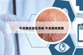 牛皮癬皮損處發(fā)癢 牛皮癬皮膚癢