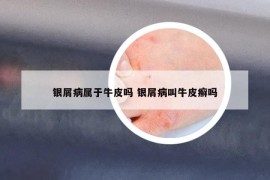 銀屑病屬于牛皮嗎 銀屑病叫牛皮癬嗎