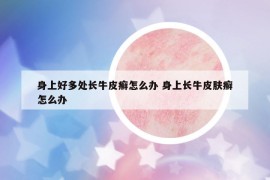 身上好多處長牛皮癬怎么辦 身上長牛皮膚癬怎么辦