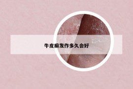 牛皮癬發(fā)作多久會好