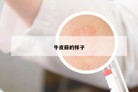 牛皮蘚的樣子