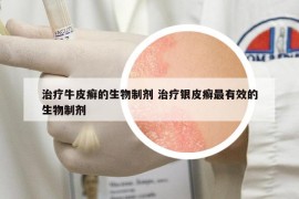 治療牛皮癬的生物制劑 治療銀皮癬最有效的生物制劑