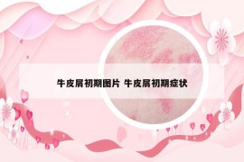 牛皮屑初期圖片 牛皮屑初期癥狀