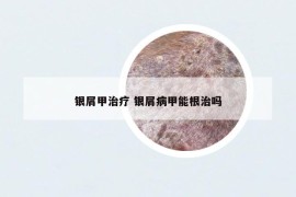 銀屑甲治療 銀屑病甲能根治嗎