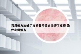 我用偏方治好了皮癬我用偏方治好了皮癬 治療皮癬偏方
