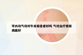 學(xué)內(nèi)功氣功對牛皮癬患者好嗎 氣功治療銀屑病最好