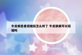 牛皮癬患者結(jié)婚后怎么樣了 牛皮膚癬可以結(jié)婚嗎
