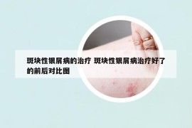 斑塊性銀屑病的治療 斑塊性銀屑病治療好了的前后對(duì)比圖