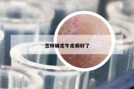 怎樣確定牛皮癬好了