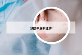 預(yù)防牛皮癬遺傳