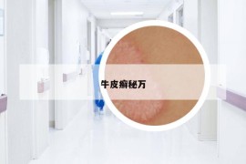 牛皮癬秘萬