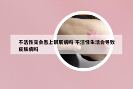 不潔性交會患上銀屑病嗎 不潔性生活會導(dǎo)致皮膚病嗎