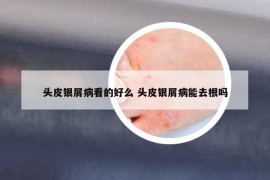 頭皮銀屑病看的好么 頭皮銀屑病能去根嗎
