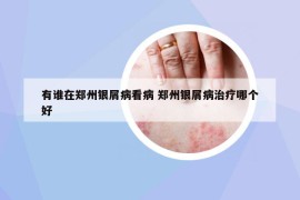 有誰在鄭州銀屑病看病 鄭州銀屑病治療哪個(gè)好