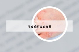 牛皮癬可以吃海苔