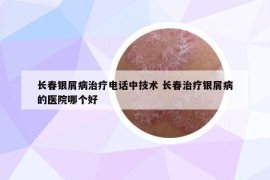 長春銀屑病治療電話中技術(shù) 長春治療銀屑病的醫(yī)院哪個好