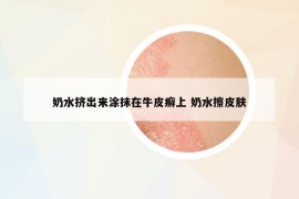 奶水擠出來涂抹在牛皮癬上 奶水擦皮膚