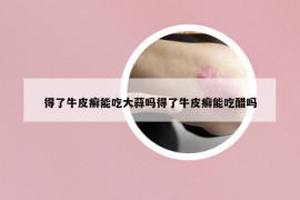 得了牛皮癬能吃大蒜嗎得了牛皮癬能吃醋嗎
