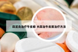 蒜泥灸治療牛皮癬 大蒜治牛皮屑治療方法