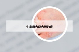 牛皮癬火燒火燎的疼