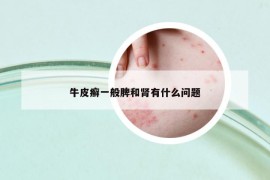 牛皮癬一般脾和腎有什么問題