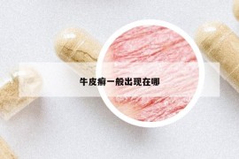 牛皮癬一般出現(xiàn)在哪