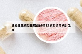 泛發(fā)性膿皰型銀屑病過程 膿皰型銀屑病并發(fā)癥