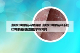盤狀紅斑狼瘡與銀屑病 盤狀紅斑狼瘡和系統(tǒng)紅斑狼瘡的區(qū)別醫(yī)學教育網(wǎng)