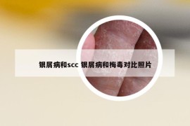 銀屑病和scc 銀屑病和梅毒對比照片