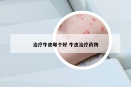 治療牛皮哪個好 牛皮治療藥物