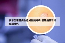 關(guān)節(jié)型銀屑病會(huì)造成腳腕疼嗎 銀屑病關(guān)節(jié)炎腳跟痛嗎