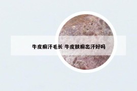 牛皮癬汗毛長 牛皮膚癬出汗好嗎