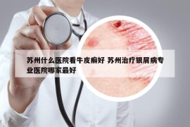 蘇州什么醫(yī)院看牛皮癬好 蘇州治療銀屑病專業(yè)醫(yī)院哪家最好