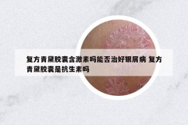 復(fù)方青黛膠囊含激素嗎能否治好銀屑病 復(fù)方青黛膠囊是抗生素嗎
