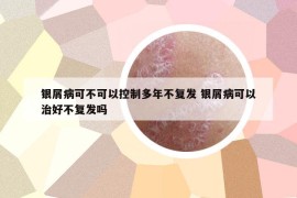 銀屑病可不可以控制多年不復(fù)發(fā) 銀屑病可以治好不復(fù)發(fā)嗎