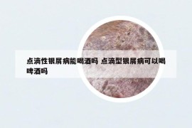 點滴性銀屑病能喝酒嗎 點滴型銀屑病可以喝啤酒嗎
