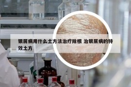 銀屑病用什么土方法治療除根 治銀屑病的特效土方