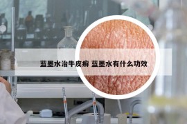 藍墨水治牛皮癬 藍墨水有什么功效