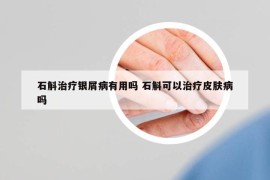 石斛治療銀屑病有用嗎 石斛可以治療皮膚病嗎