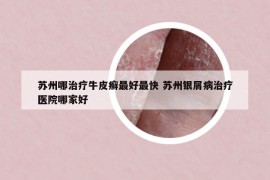 蘇州哪治療牛皮癬最好最快 蘇州銀屑病治療醫(yī)院哪家好