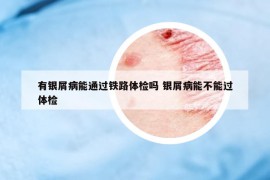 有銀屑病能通過(guò)鐵路體檢嗎 銀屑病能不能過(guò)體檢